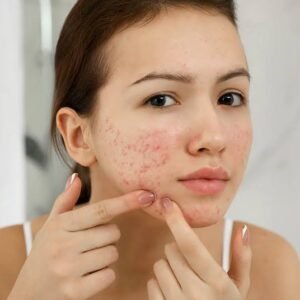 Acne Control Combo