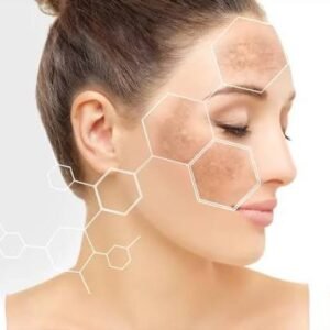 Melasma / Pigmentation Treatment